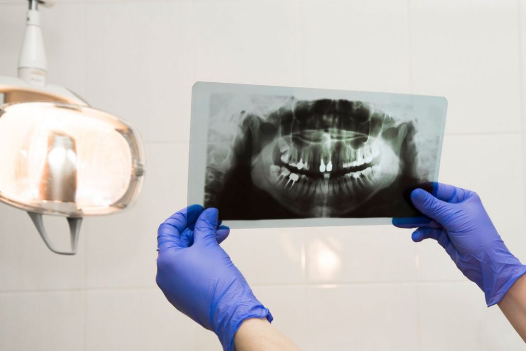 dentista com luva azul segurando radiografia contra luz