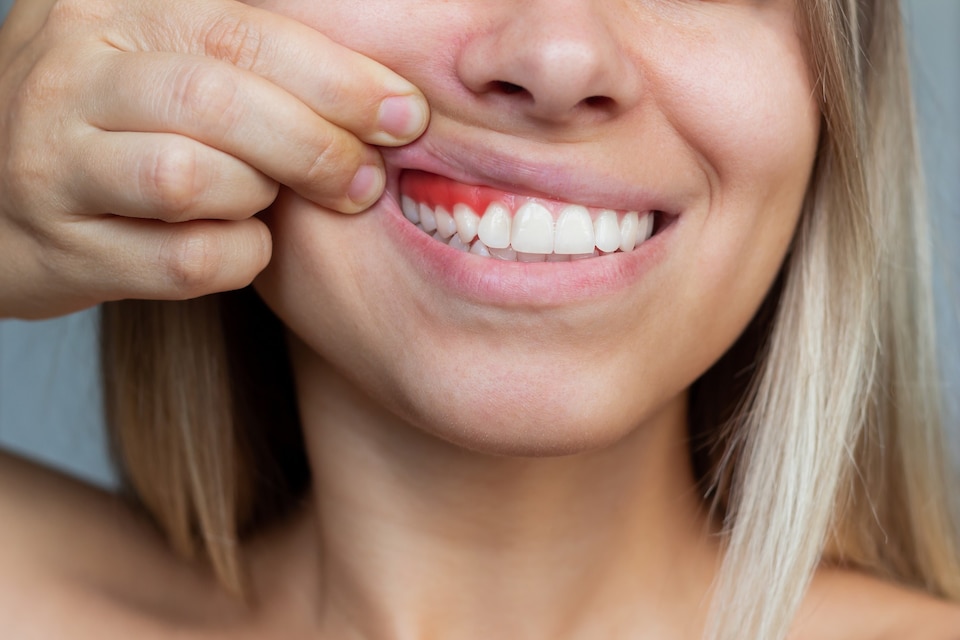 mulher puxando seu lábio superior para mostrar inflamação na gengiva