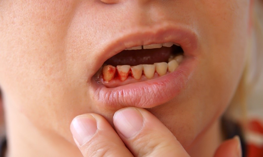 homem puxando o lábio inferior e mostrando sangramento nos dentes