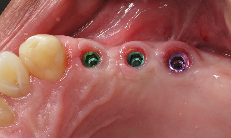 fazendo implante sem cortes