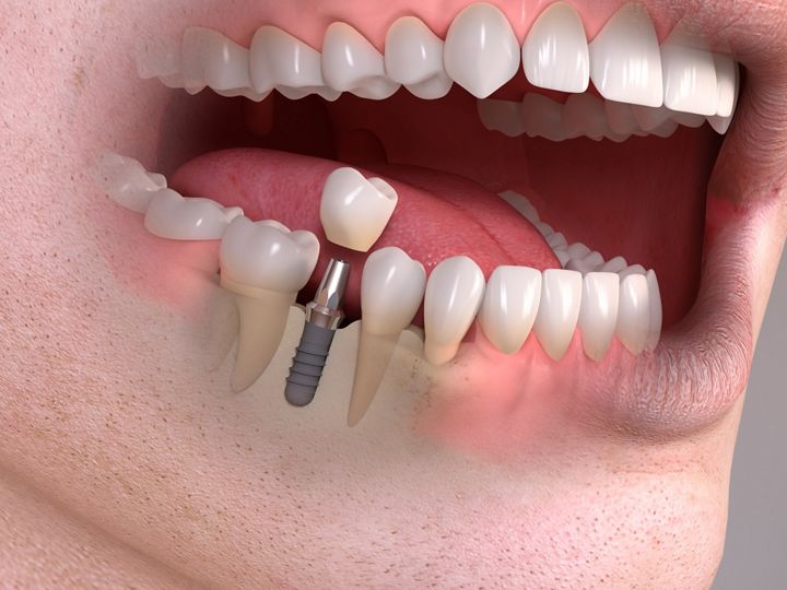 Imagem de homem com a boca aberta e com pino de metal