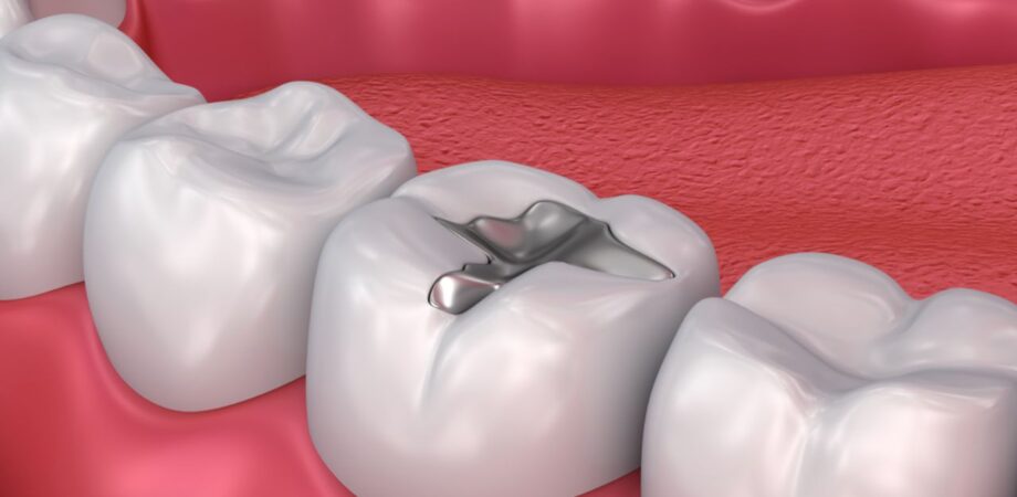 Dente com bloco de metal