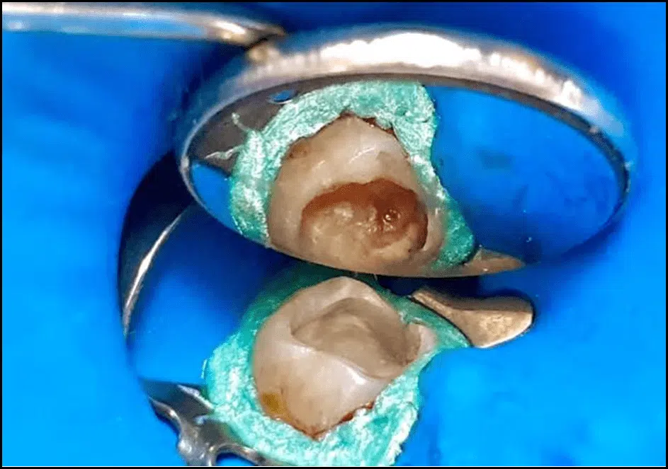 Capeamento pulpar direto