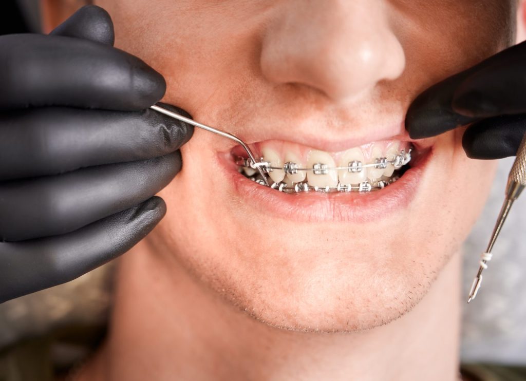 Close up mãos do dentista colocando elástico nos dentes do paciente. Homem com aparelho metálico com fio nos dentes recebendo tratamento ortodôntico em clínica odontológica. 