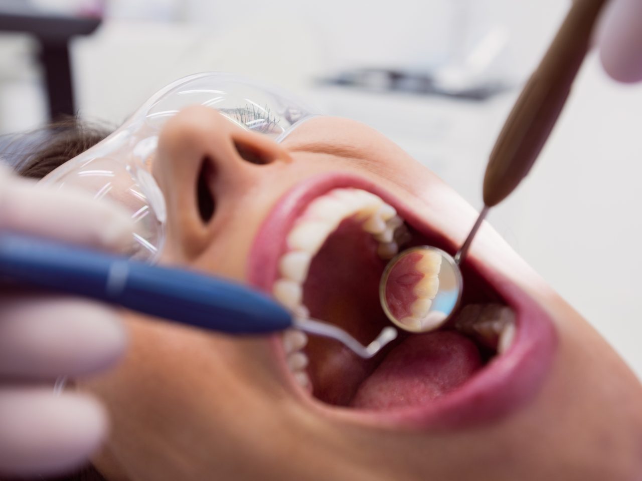 Boca de paciente aberta no dentista enquanto se olha a parte de dentro do dente com espelhinho