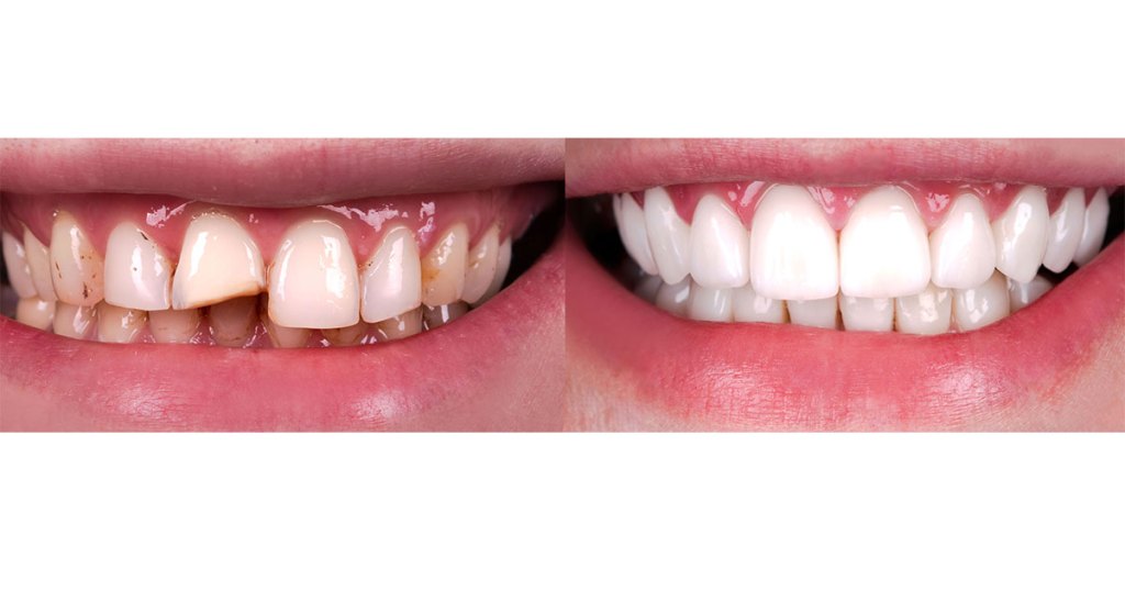 Antes e depois dos dentes sendo restaurados