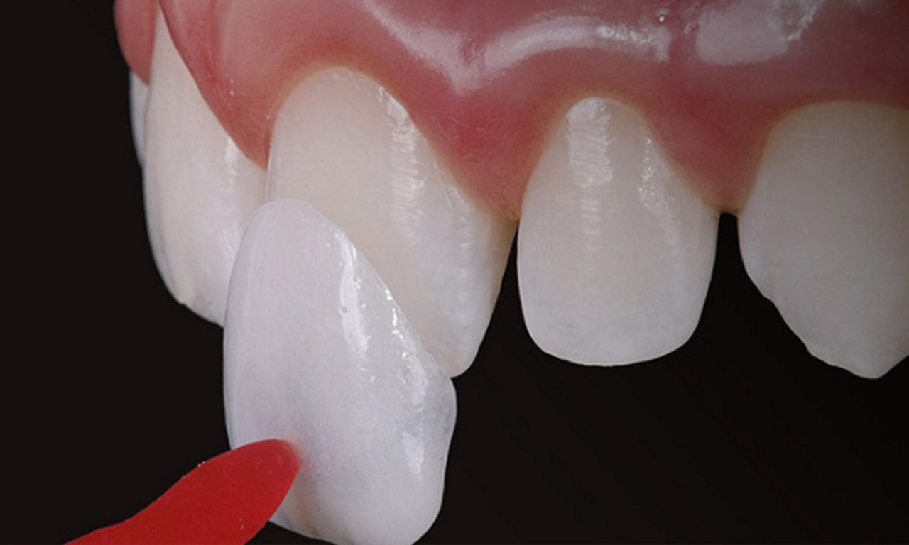 Colocando uma faceta no dente.