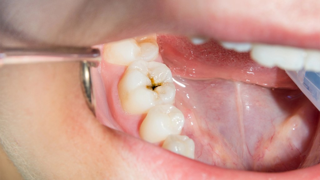 Dentista puxa com o espelho para ter mais acesso ao fundo da boca onde tem uma cárie no dente.