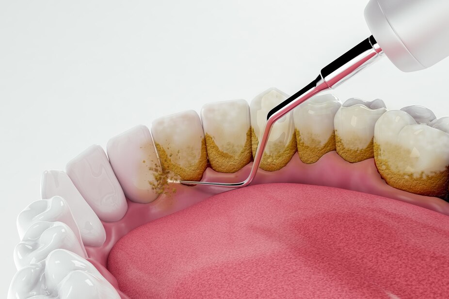Imagem 3D de limpeza dental. Está retirando tartáro.