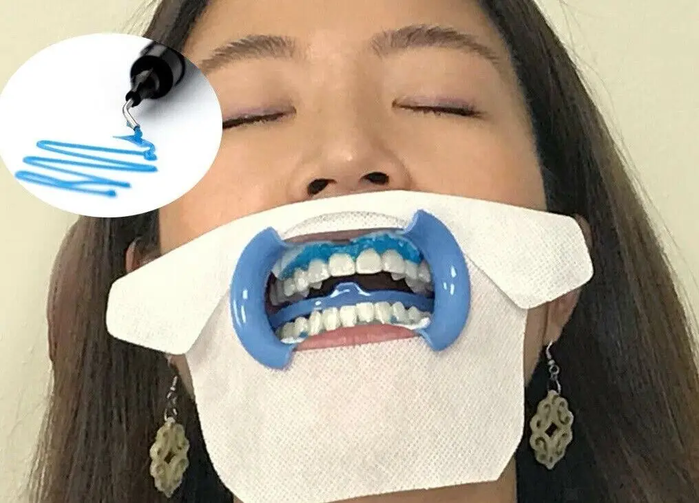 Paciente mulher de cabelo solto liso passando por clareamento dental, em sua boca há um gel protegendo sua gengiva, no canto da imagem está mostrando o gel