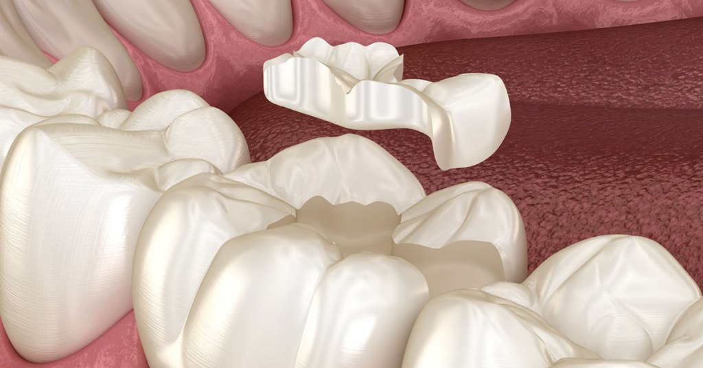 Desenho 3d mostrando uma restauração inlay sendo colocada