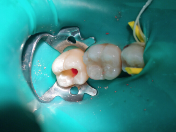 Realizando Tratamento expectante em dente de paciente