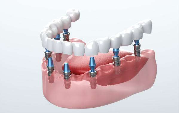 Imagem digital de dentes de cerâmicas sendo implantados na boca, fundo da imagem é branco
