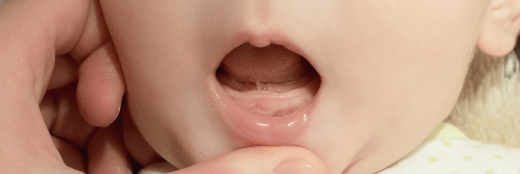 imagem de puxando lábio inferior de bebê para baixo, para poder ver o freio