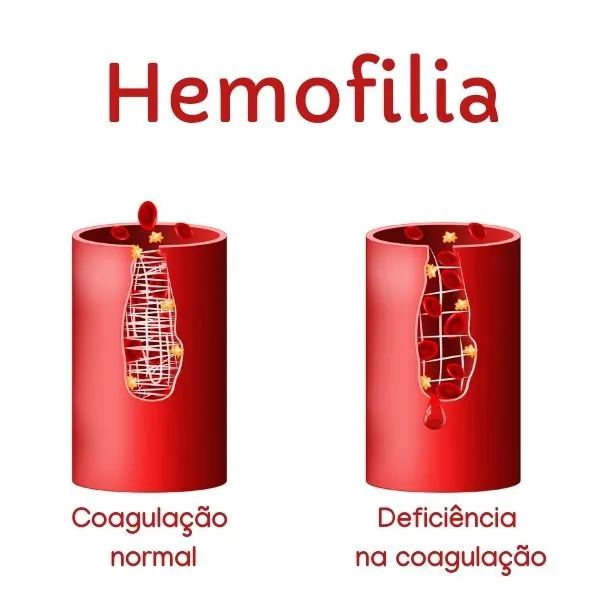 imagem mostrando diferença na coagulação normal e na coagulação de alguém com hemofilia