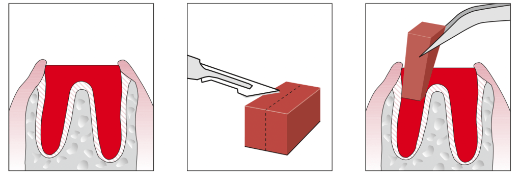 sequência de desenhos mostrando como parar hemorragia dentária