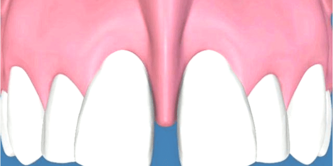 imagem 3d de freio longo entre os dentes