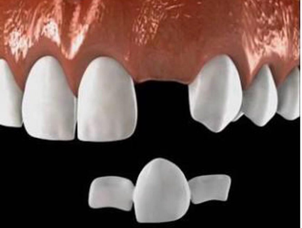 imagem 3d mostrando prótese dentária sendo colocada