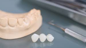 prótese dentária, junto com molde de boca e instrumento odontológico em cima de mesa