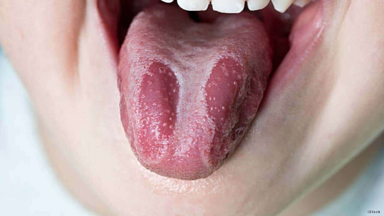 pessoa mostrando língua com síndrome da boca ardente