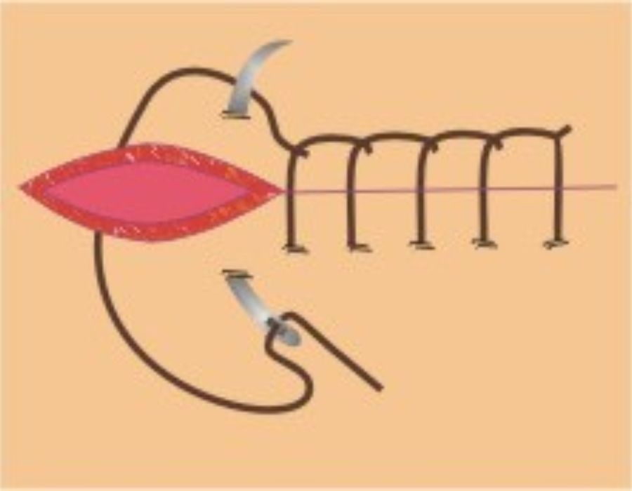 Sutura Ponto contínuo festonado