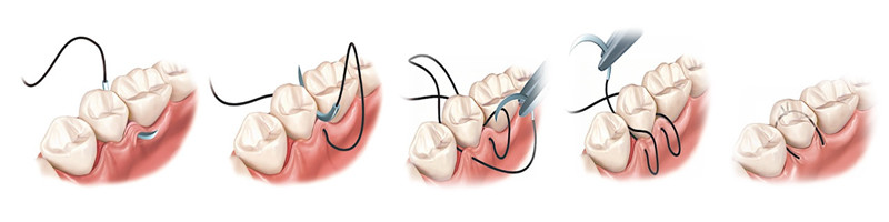 Desenho em 3d mostrando passo-a-passo de uma sutura na boca