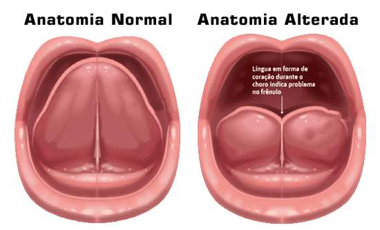 imagem comparando anatomia normal e a alterada do freio da língua