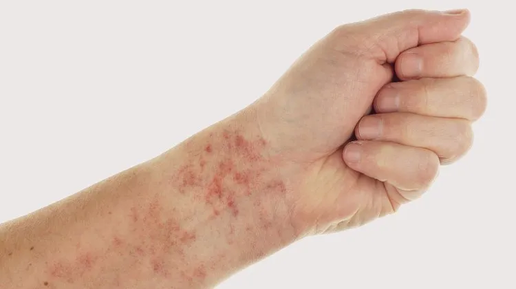 Pessoa com manchas pequenas no braço devido a Trombocitopenia.