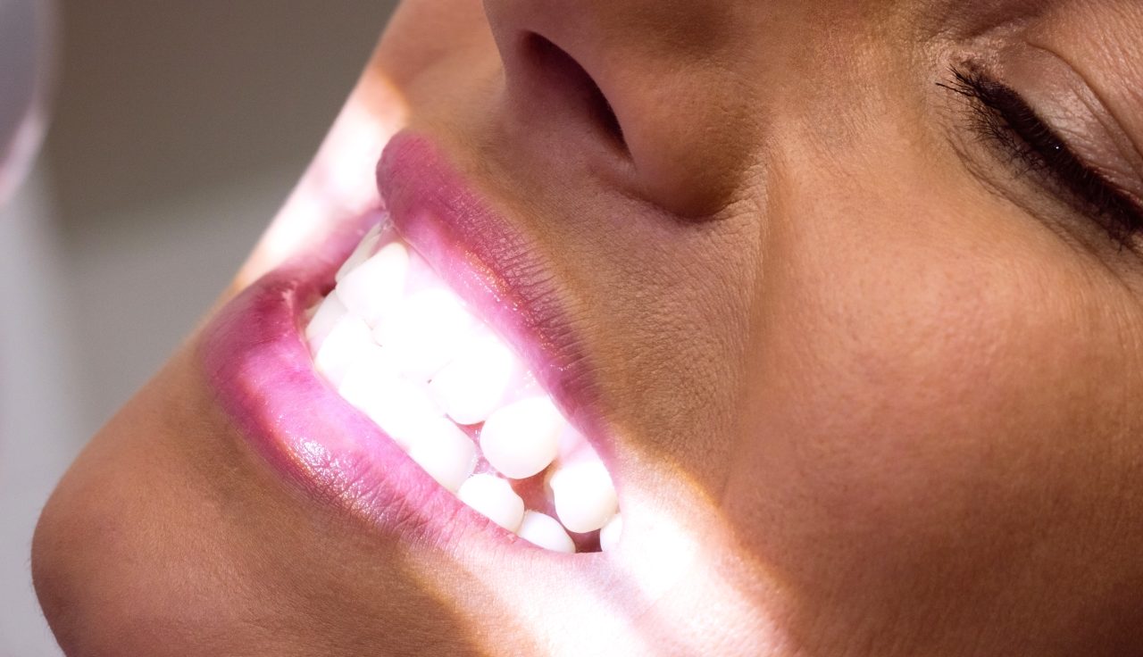 mulher em tratamento no dentista, ela está sorrindo e tem uma luz branca em seus dentes