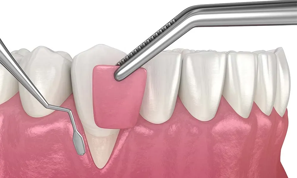3d mostrando colocando enxerto em recessão gengival