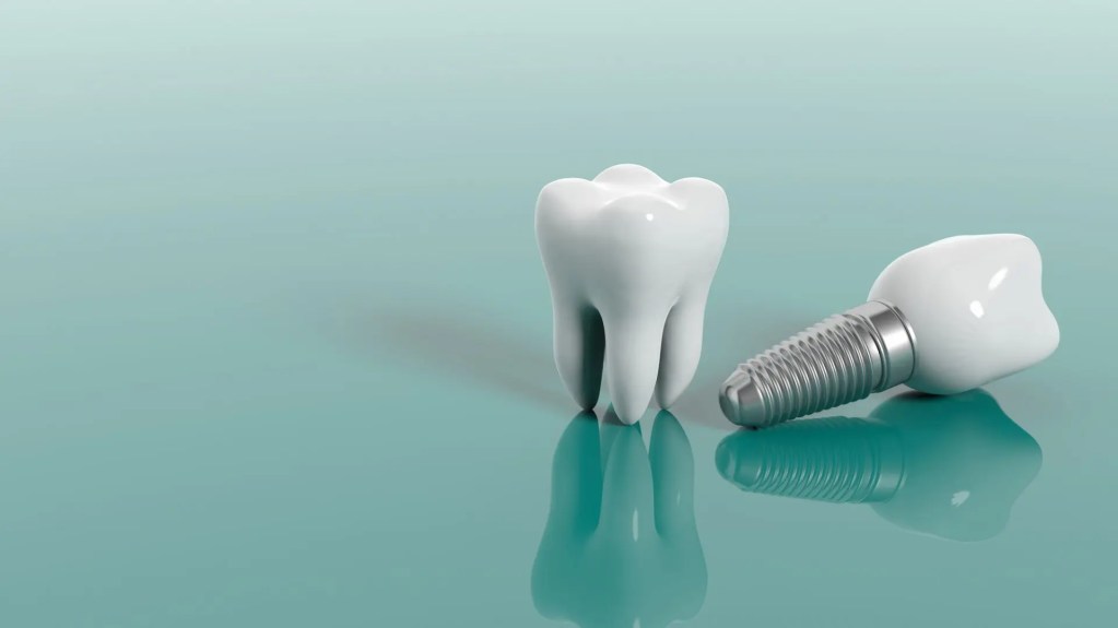 dois dentes de implante dentário