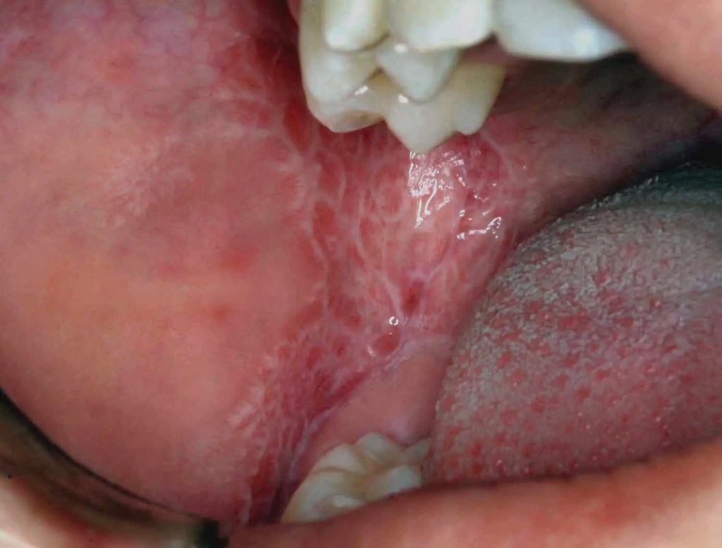 Líquen Plano Oral em boca