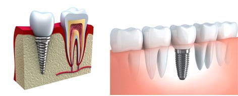 imagem mostra dois desenhos 3d de dente implantado com pino