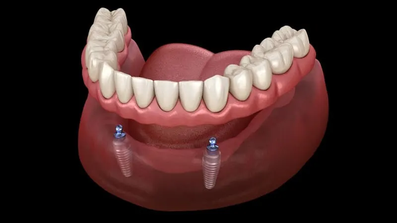 Imagem gráfica de Prótese Overdenture