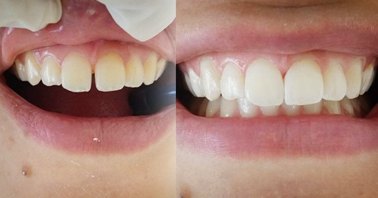 antes e depois de restauração de dente com resina, reparando o espaço entre os dentes