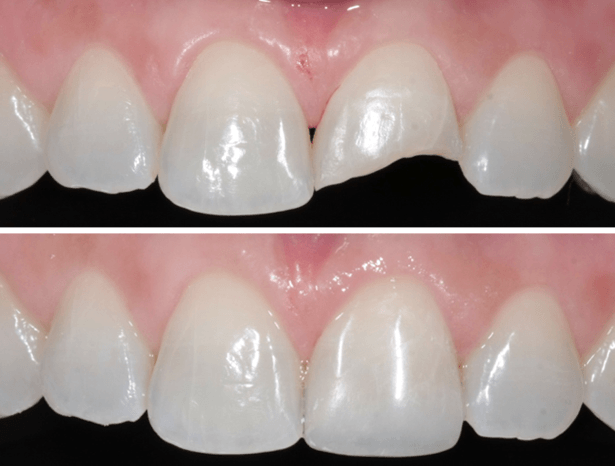 antes e depois de restauração de dente quebrado feito com resina
