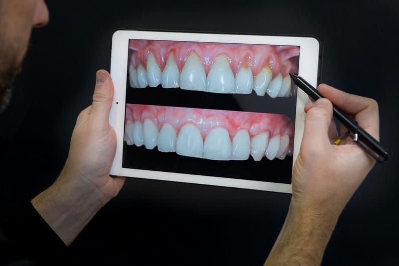 Dentista segurando tablet com caneta e mostrando antes e depois de cirurgia para recessão gengival