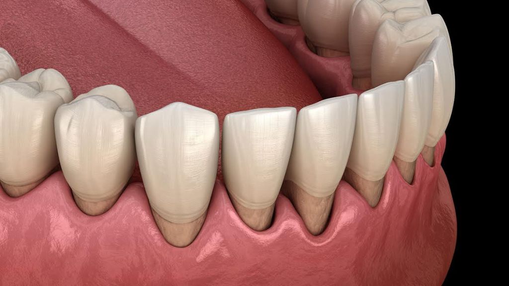 3d mostrando gengiva com recessão