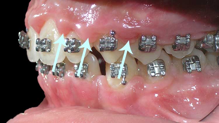 Boca de pessoa com aparelho ortodôntico causando retração gengival, na imagem tem setas apontando para a recessão