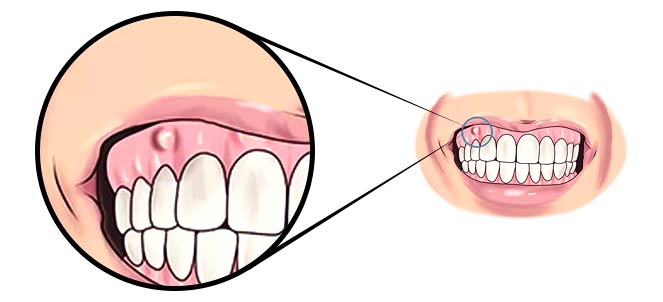 Zoom em desenho que mostra abscesso dental - ou seja, tem uma bolha na gengiva dela.