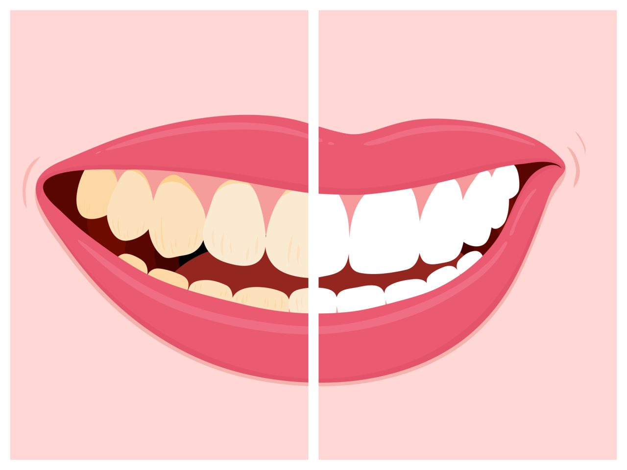 desenho digital de antes e depois de clareamento dental