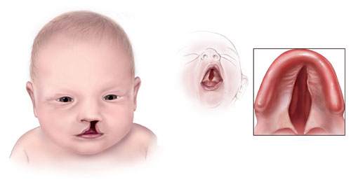 imagem desenhada mostrando bebê com lábio leporino e fissura palatina