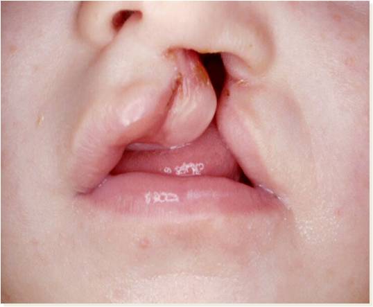 boca de criança com lábio leporino