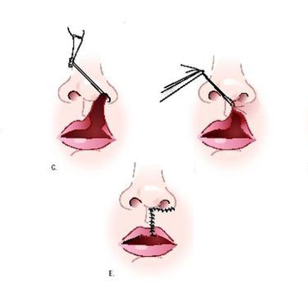 ilustração mostrando os passos da cirurgia para lábio leporino