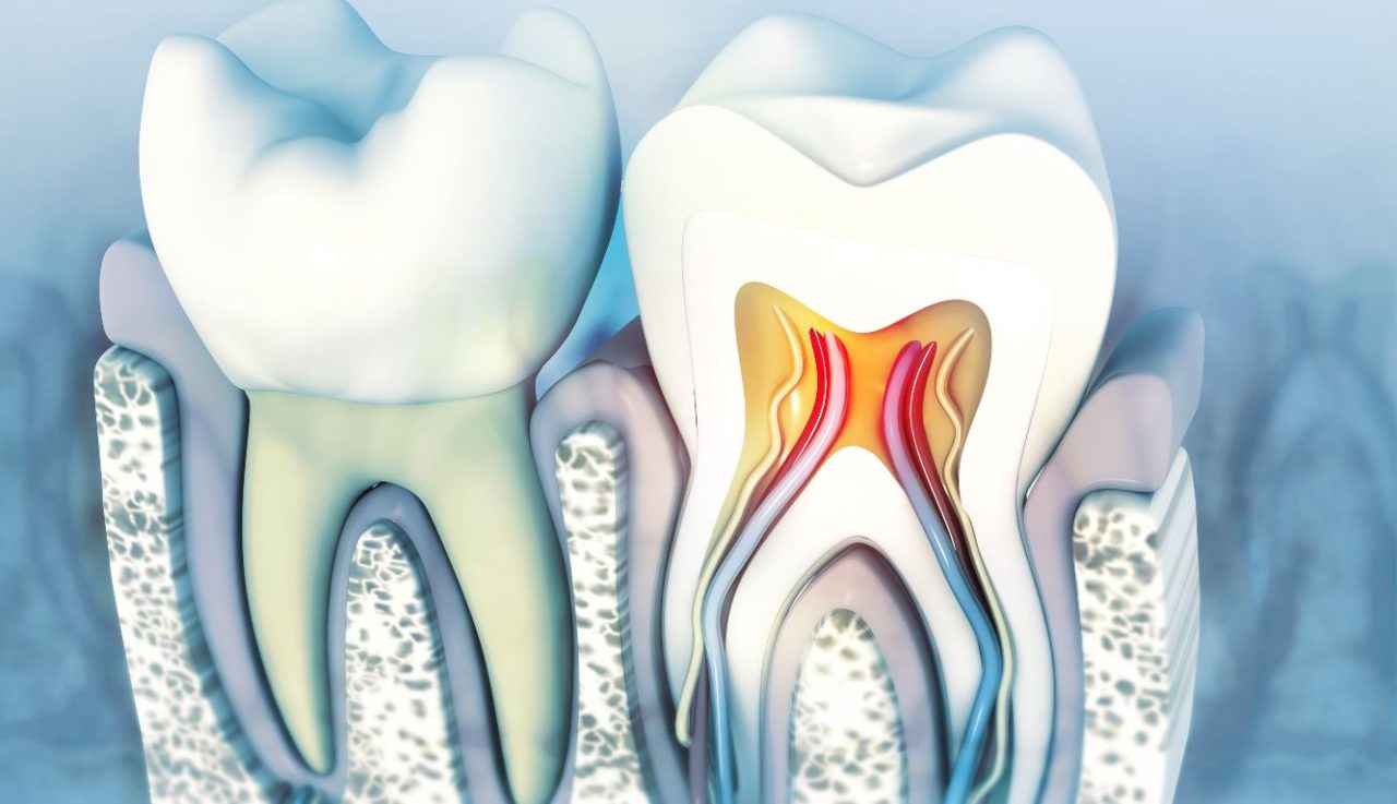 desenho digital de dente com inflamação na polpa