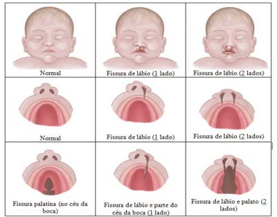 Desenho demonstrando a diferença do lábio leporino com uma e com duas fissuras, e a fissura palatina