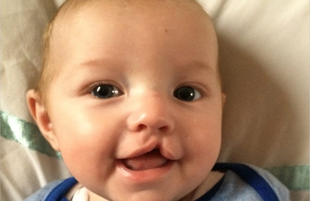 Bebê com lábio leporino
