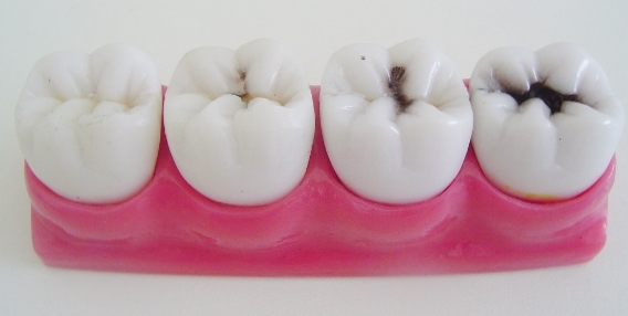 Molde de dentes falsos mostrando a evolução de uma cárie dental.