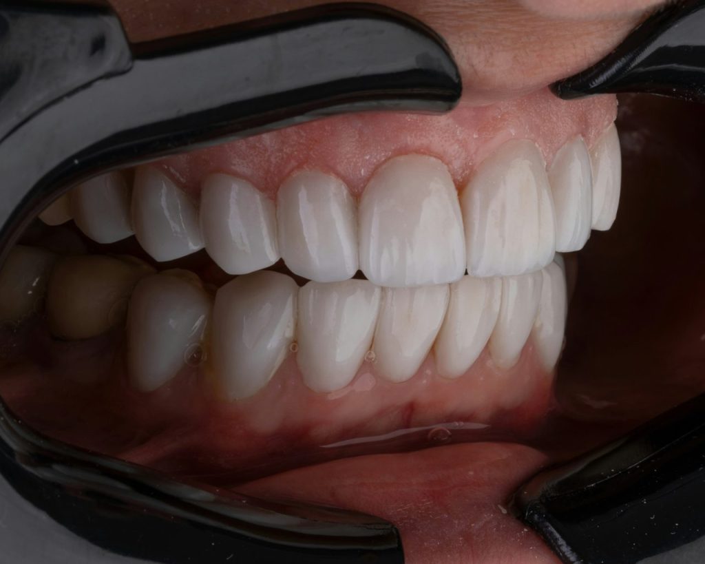 Imagem aproximada de dentes de paciente, está sendo utilizado um afastador para deixar a boca do paciente aberto