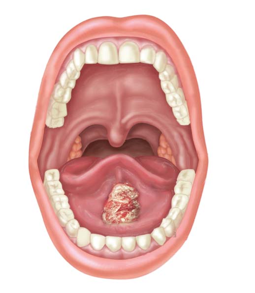 desenho digital de uma boca aberta que possui um câmcer de boca